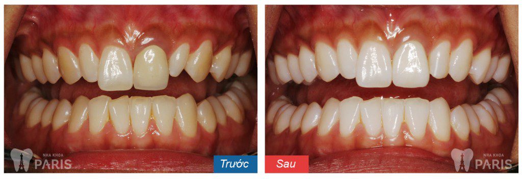 Hiệu quả tẩy trắng răng laser tại Nha khoa Paris đã được kiểm chứng