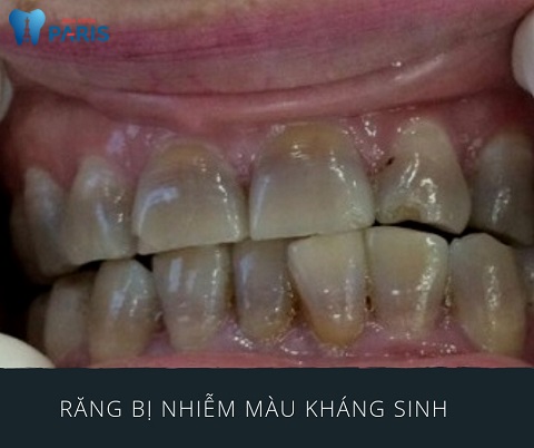 Răng nhiễm màu kháng sinh là gì? Có tẩy trắng được không?