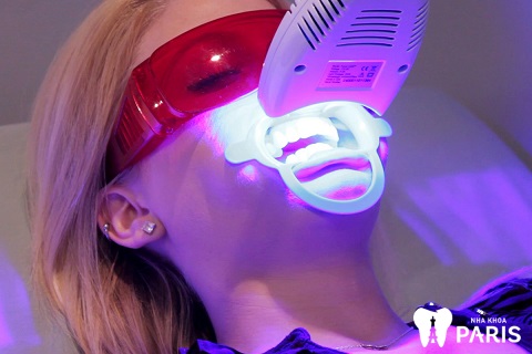 Tẩy trắng răng ánh sáng Laser tại Nha khoa Paris