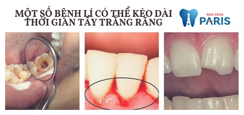 Các bệnh lý răng miệng thường gặp