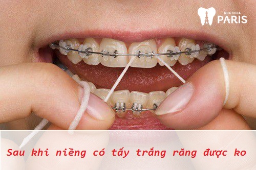 Tẩy trắng răng sau khi niềng: Nên hay không?