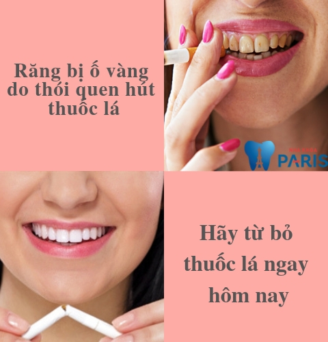 Thói quen hút thuốc lá làm răng bị ố vàng mất thẩm mỹ