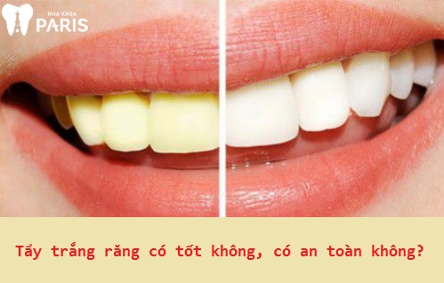 Tẩy trắng răng có tốt, có an toàn không?