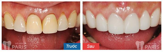 Hình ảnh khách hàng Lê Anh Quân trước và sau khi tẩy trắng răng ở Hải Phòng