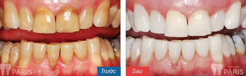 Hình ảnh khách hàng Lê Anh Quân trước và sau khi tẩy trắng răng ở Hải Phòng