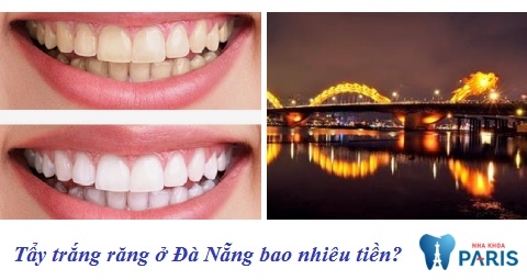 Tẩy trắng răng ở Đà Nẵng bao nhiêu tiền