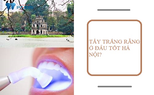 Tẩy trắng răng ở đâu tốt Hà Nội - Bệnh viện công hay phòng khám tư? 