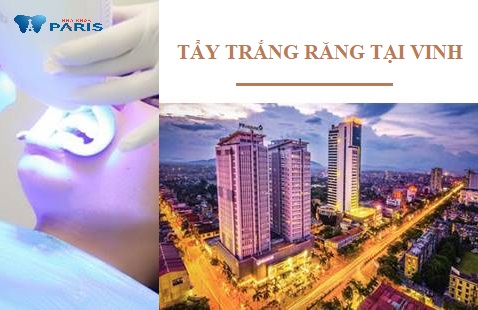 4 cách tìm địa chỉ tẩy trắng răng tại Vinh tốt. 