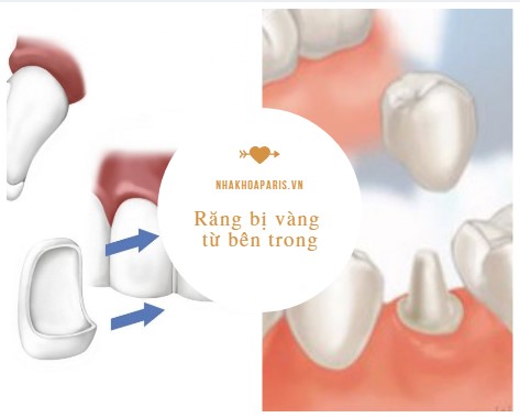 Bọc răng sứ hoặc dán veneer cho răng bị vàng từ bên trong do yếu tố nội sinh