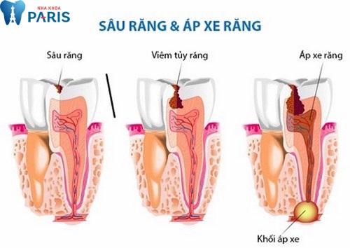 Sâu răng là nguồn gốc hình thành ổ áp xe