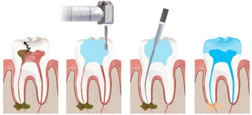 Khoan răng, rút bỏ tủy đã bị viêm và khử trùng ống tủy