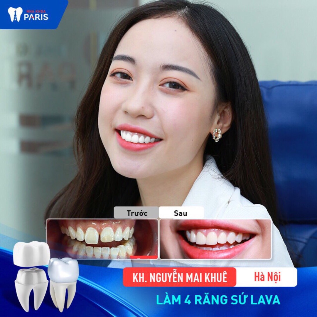 Tự tin làm răng thẩm mỹ tại nha khoa Paris